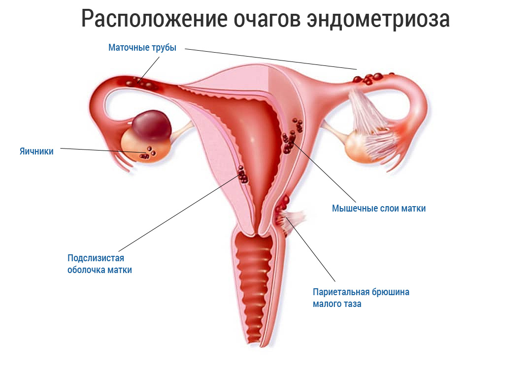 Женские эндометрии. Эндометриоз матки гинекология. Эндометриоз менструация. Наружный генитальный эндометриоз.